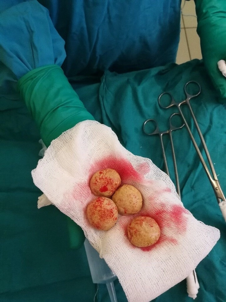 Хирурги из ГКБ №52 удалили из мочевого пузыря москвича 150 граммов камней